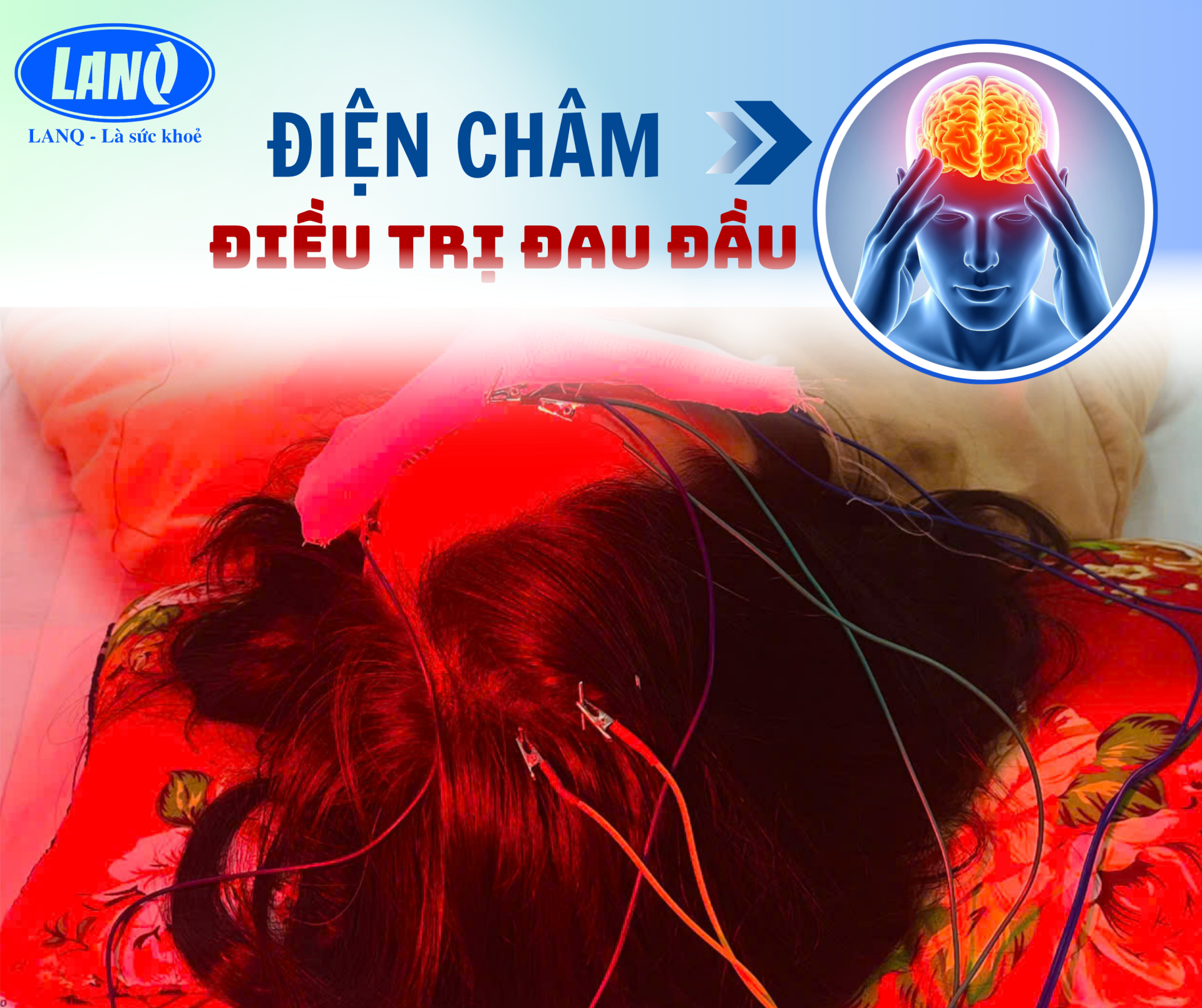 ỨNG DỤNG CỦA ĐIỆN CHÂM TRONG ĐIỀU TRỊ ĐAU ĐẦU