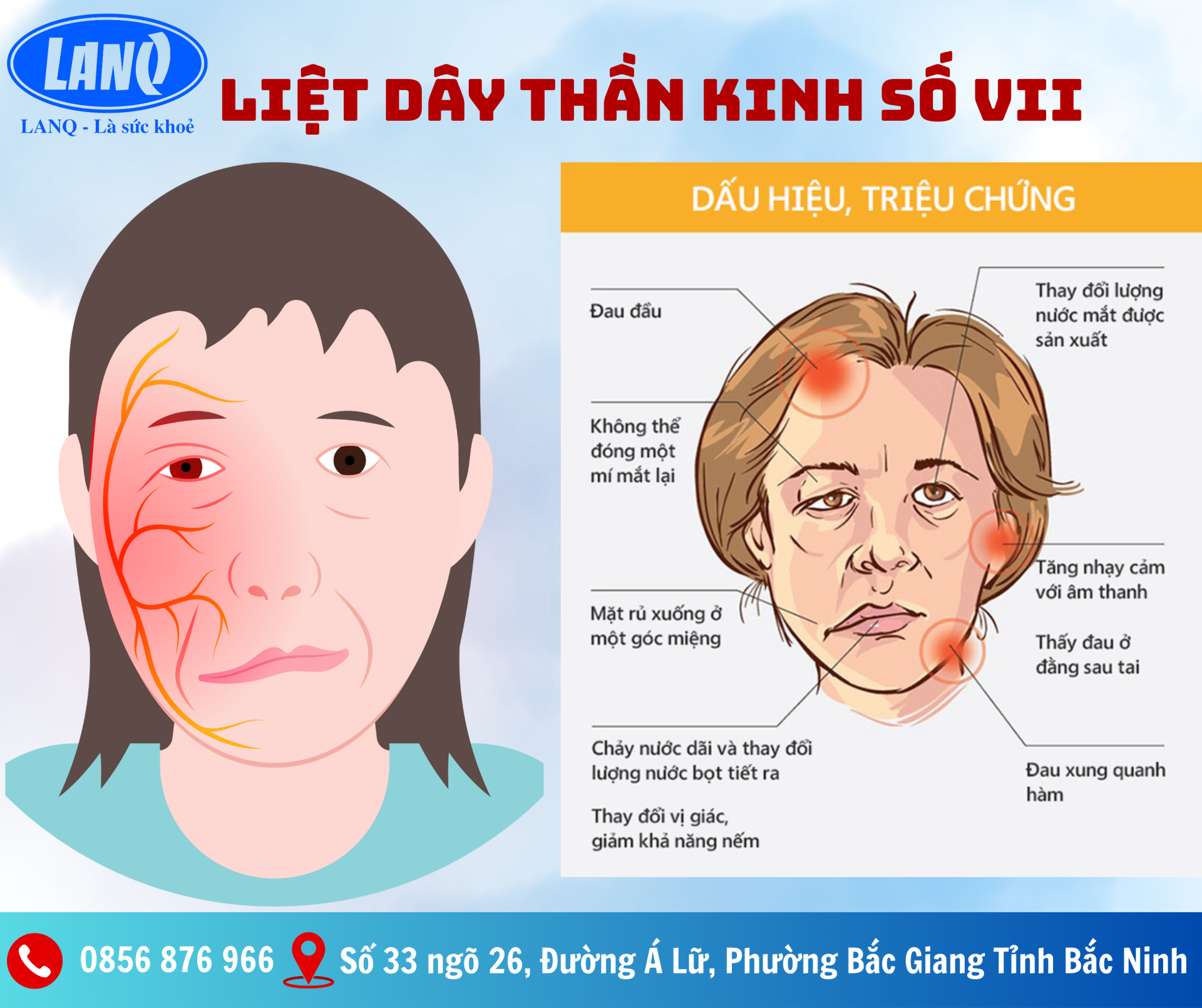 BỆNH LIỆT DÂY THẦN KINH SỐ VII