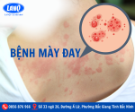BỆNH MÀY ĐAY ( PHONG CHẨN )